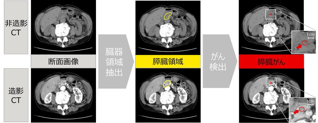 開発する技術による膵臓がんの疑いがある部位の検出イメージ